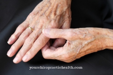 kas yra artritas rankos
