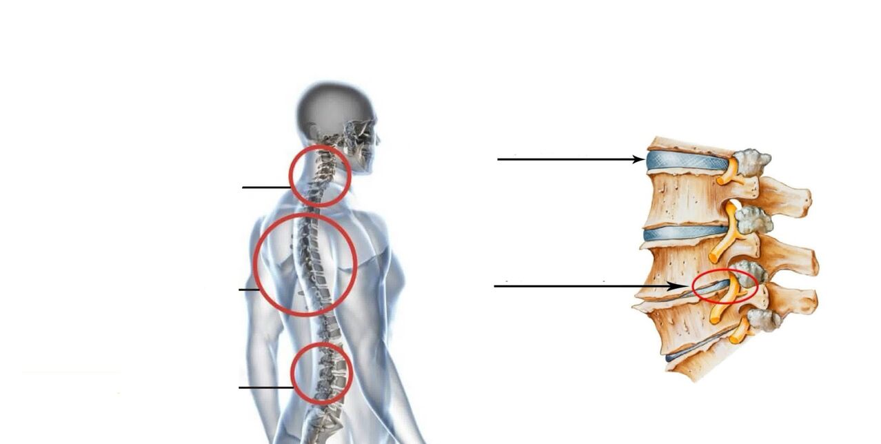 osteochondrozė kremas gelis kaina artrito pirštais poveikis