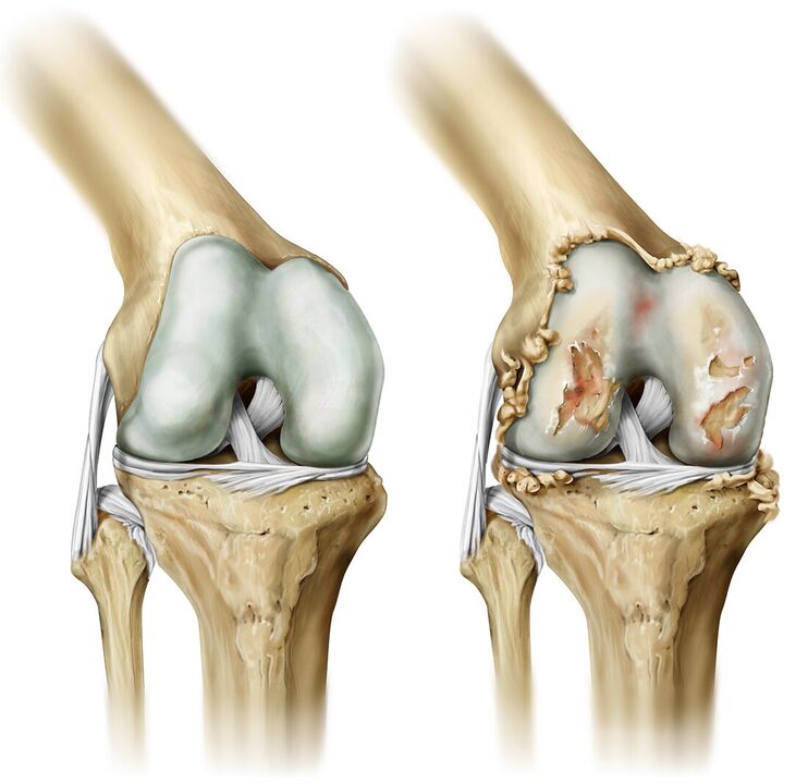 artrozė gydymo pėdų tradiciniai metodai veiksmingas tepalas skausmo sąnariuose atsiliepimus