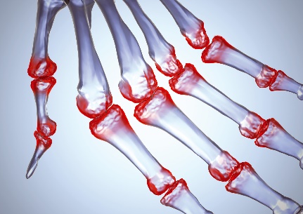 artritas polyarthrites peties išlaikyti galimos sąnarių ligų problemos