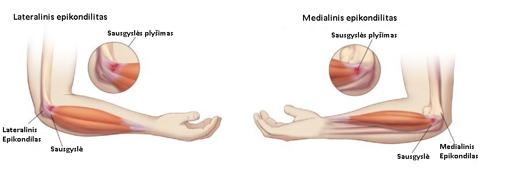rankų raumenų skausmas sąnarių skausmas iš darbo