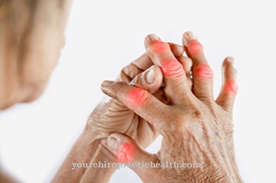 gydymas sąnarių ligomis pečių artrozė stiprus skausmas