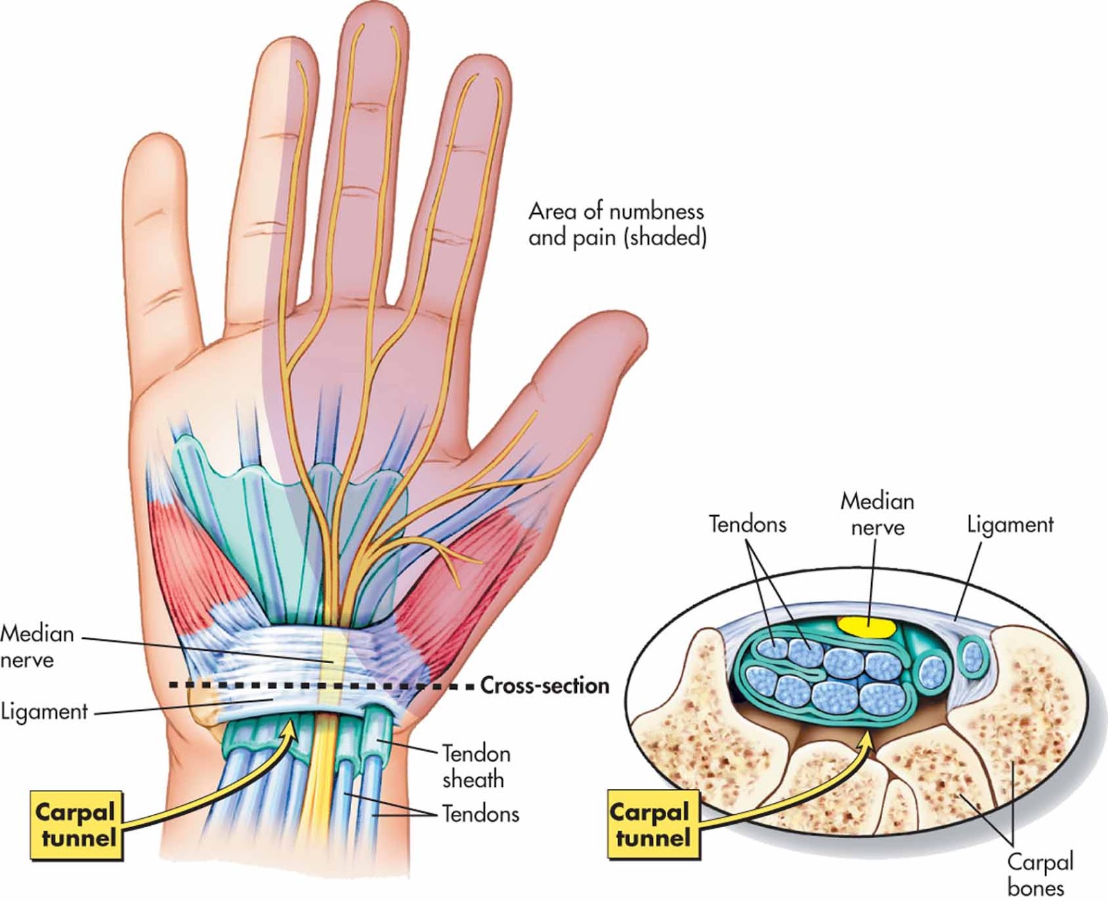 sąnarių skausmas po to kai veikia artritas riešo rankos