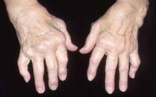 artritas riešo rankos