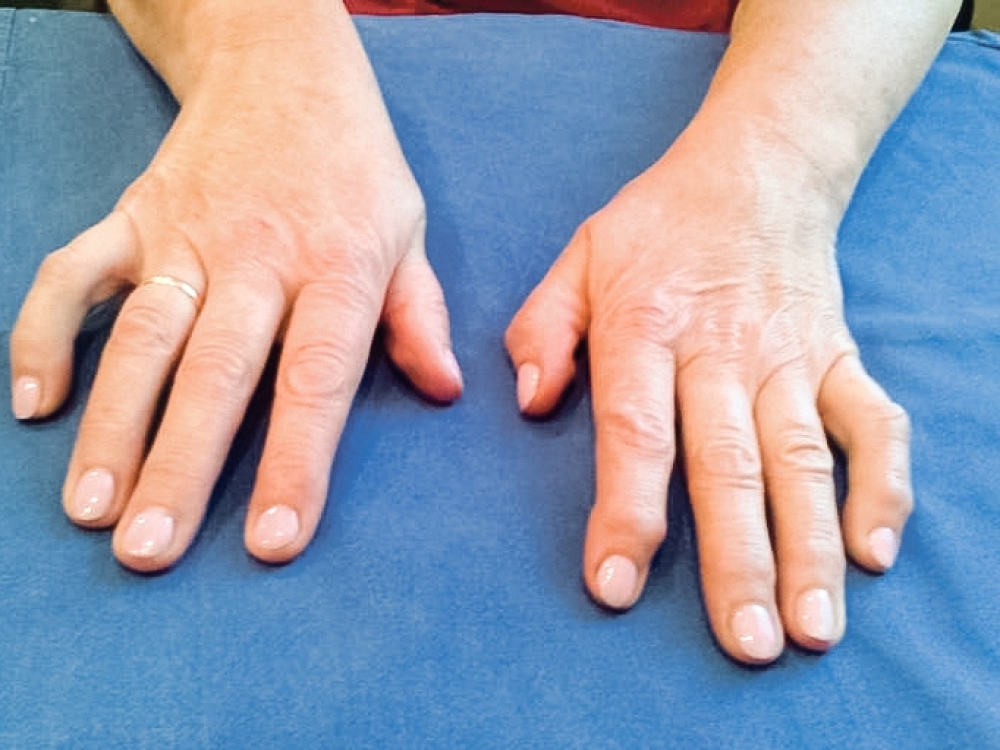 rankos sergantys rankos gydymas kalkių sąnario