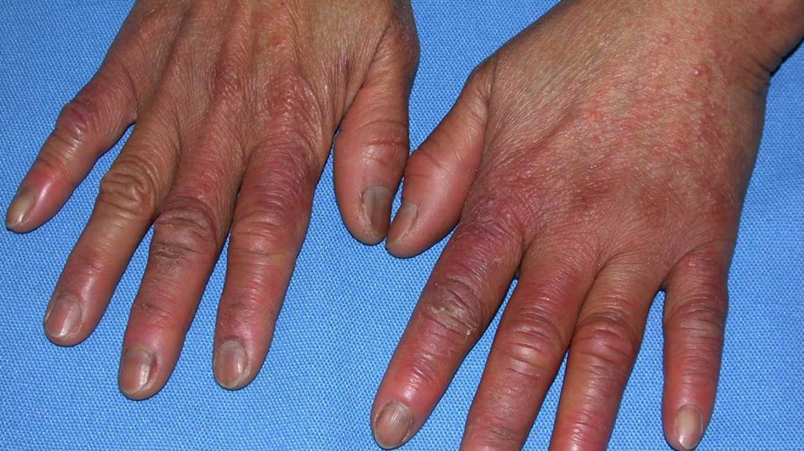 swelling in finger joints due to cold