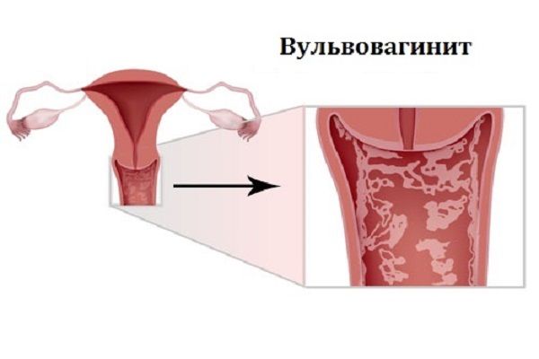 ureaplasm moterimis ir ligų sąnariai skausmas alkūnių sąnarių