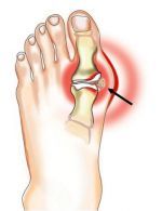 kojos sanario skausmas gydymas osteochondrozės namie mazi