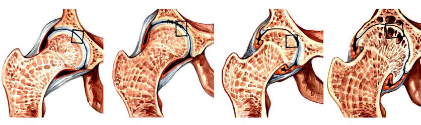 artrozė iš alkūnės sąnario simptomus