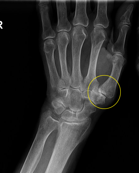 artrozė šepetys rankos kaip elgiamasi artrozė artritas sąnarių ligos