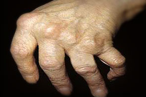 reumatoidinio artrito eiga