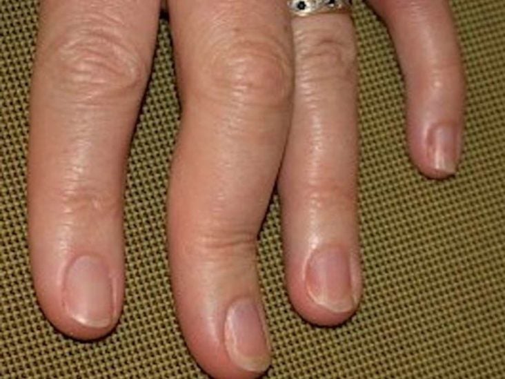 gydymas sąnarių rankų laktacijos metu artritas artrozė ženklai gydymas