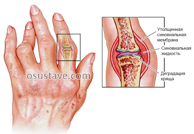 rankiniai sąnarių artritas