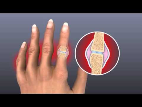 swelling in joints with pain