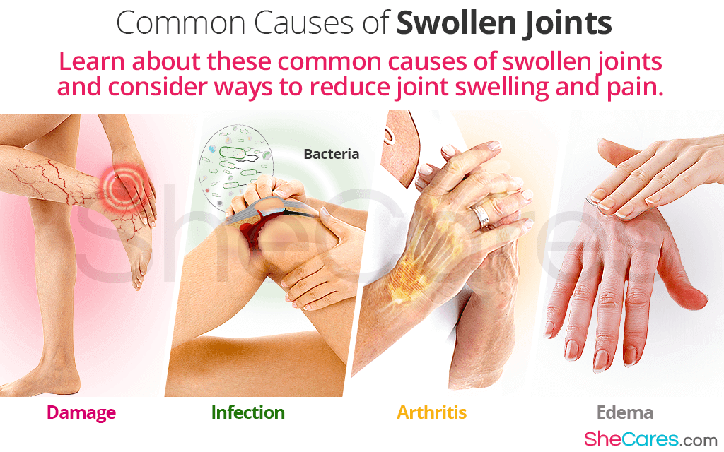 what causes edema in joints
