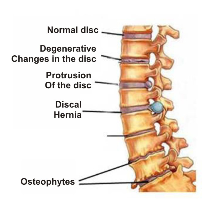 osteochondrozė ir sąnarių skausmas ant piršto į artritą