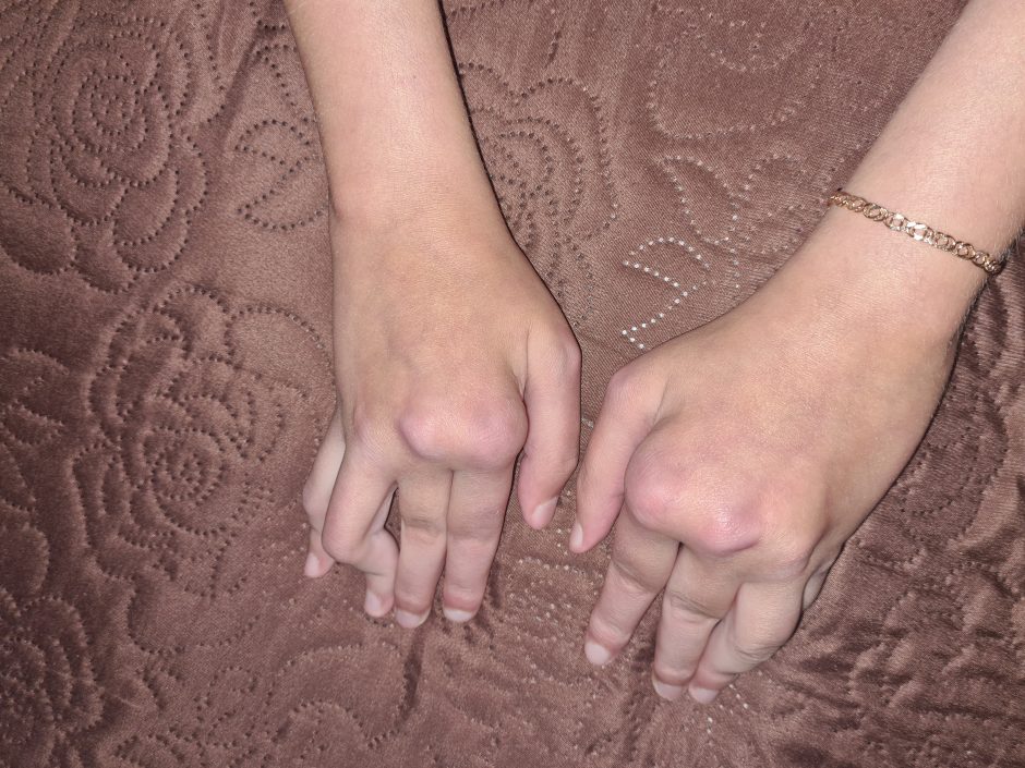 kaip nustatyti artritas rankų
