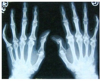 artritas radialinio kaulų ranka artrozė iš pečių sąnarių