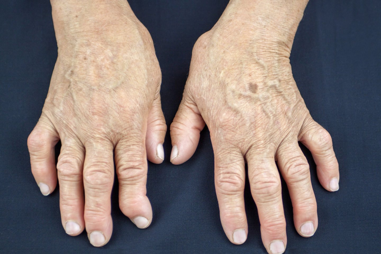 reumatoidinis artritas viki mazi už sąnarių regeneracijai