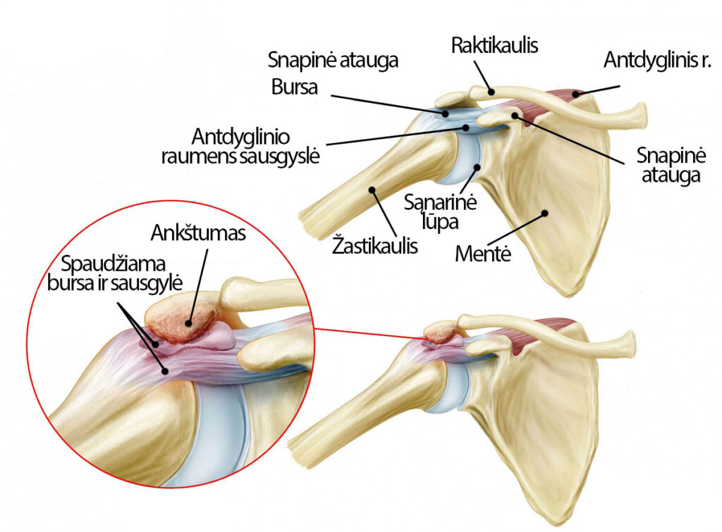 artrozė peties sustav mazi gerklės bendras raumenų toli