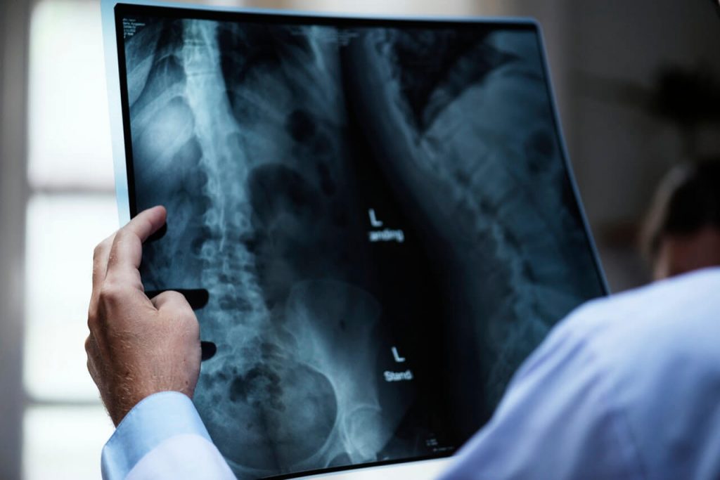 homeopatinis vaistas osteochondrozės visos nugaros artrito gydymui ant piršto