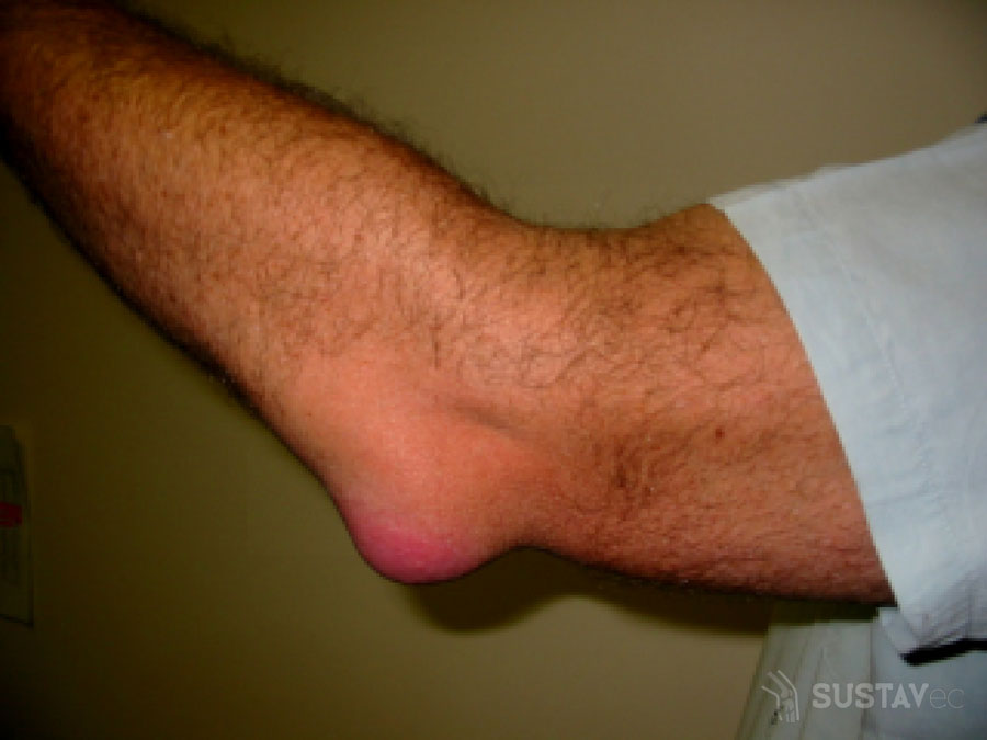 sužalojimus alkūnės sąnario artrozė 2 laipsnių pėdų gydymui nei ramus skausmo