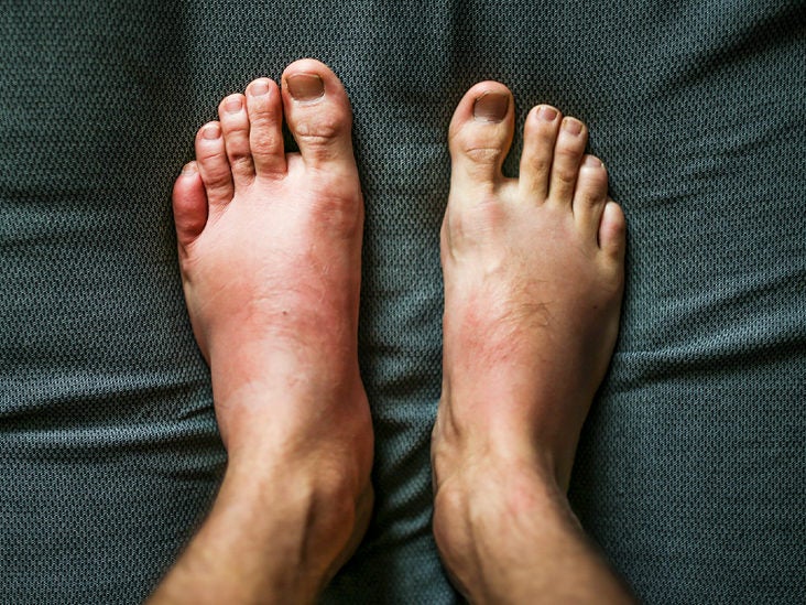 swelling in feet joints skausmas iš venų sąnarių seilinukai