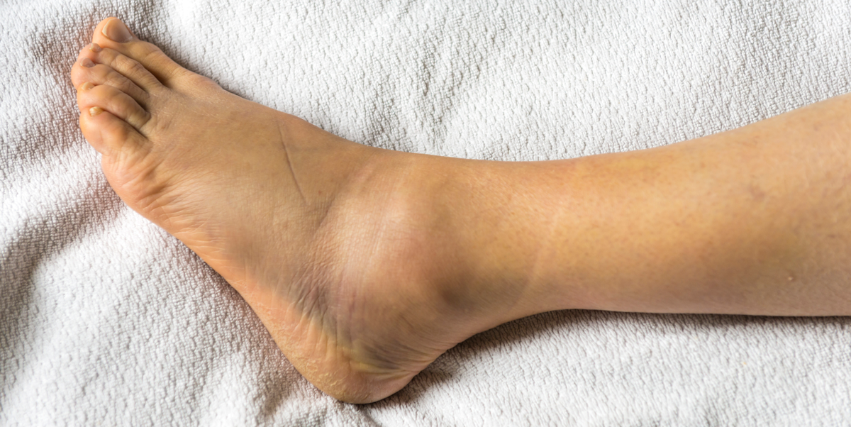 swelling in feet joints tipas bendrą 2 v ir gydymo
