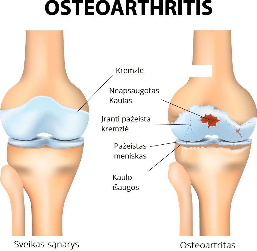 sanariu traskejimas sportuojant artritas artrozė gydymas liaudies