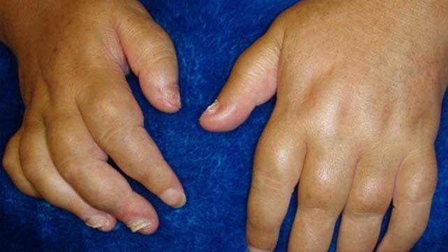 edema and painful joints skausmas artrozės siūlės