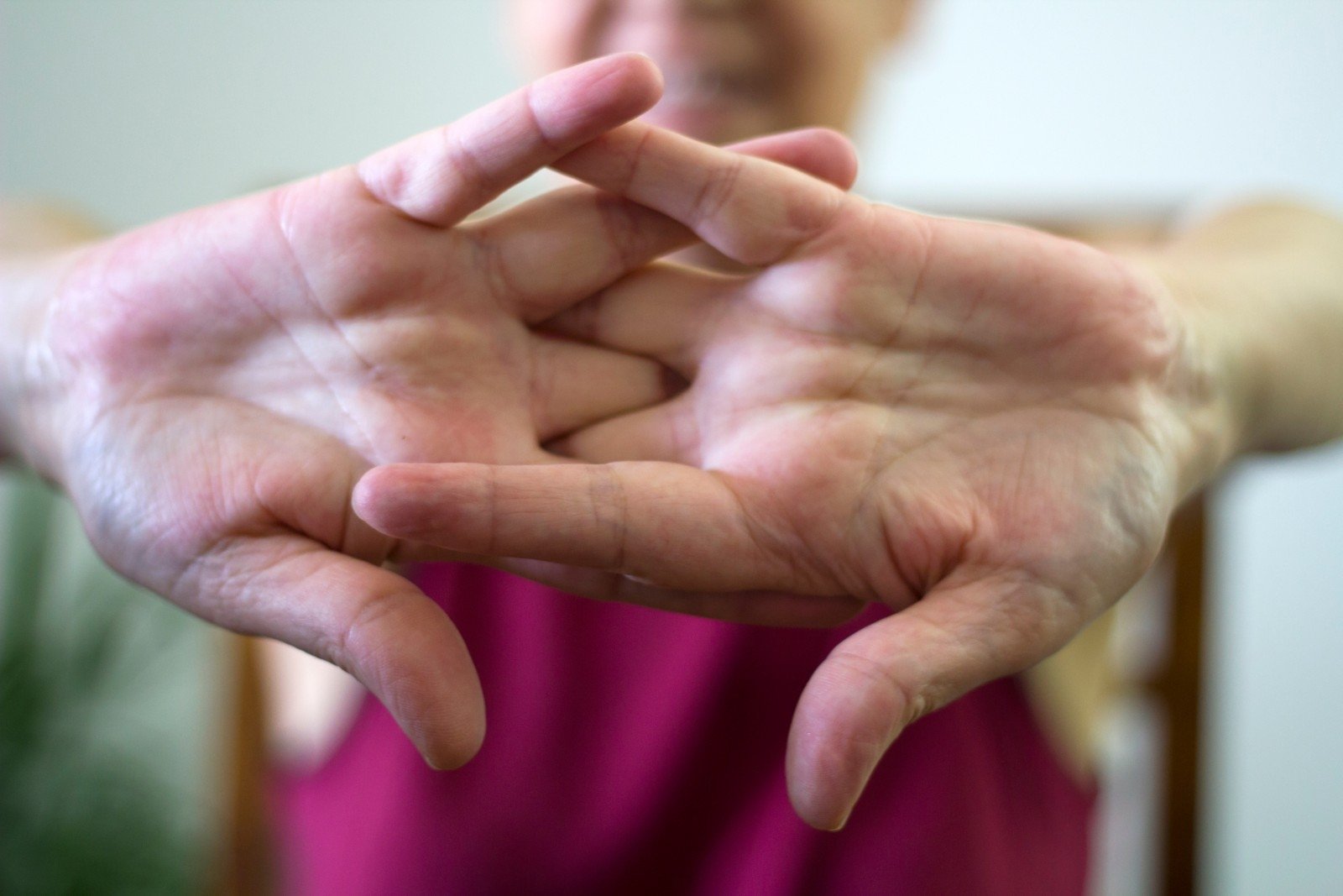 avokadų gydymas palaikimo artritas falanga pirštas