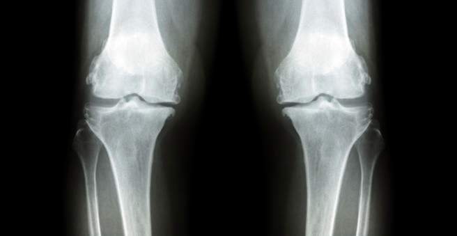 gydymas osteoartrito 3 laipsnio