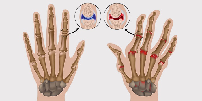 kad trigerius artrito rankas pratimai trukus peties sausgyslei