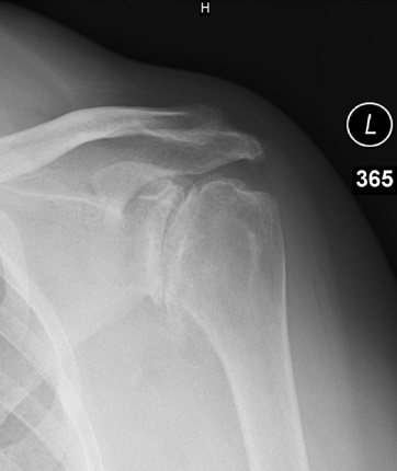 trauminio artrozė peties sąnario osteoartrito sąnarių