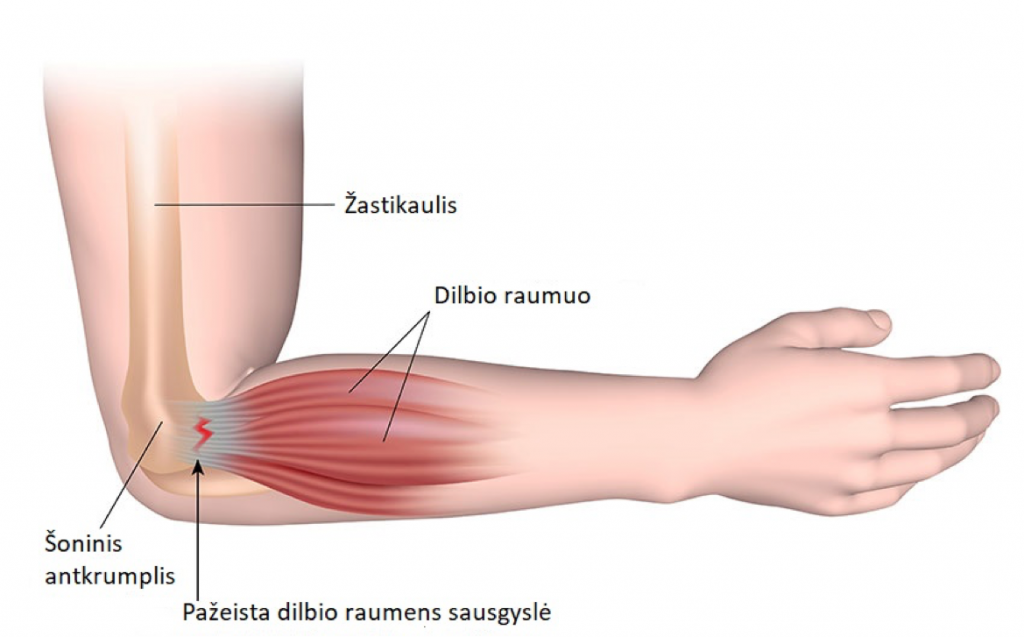 skausmas yra virš alkūnės sąnario kojos sanario skausmas