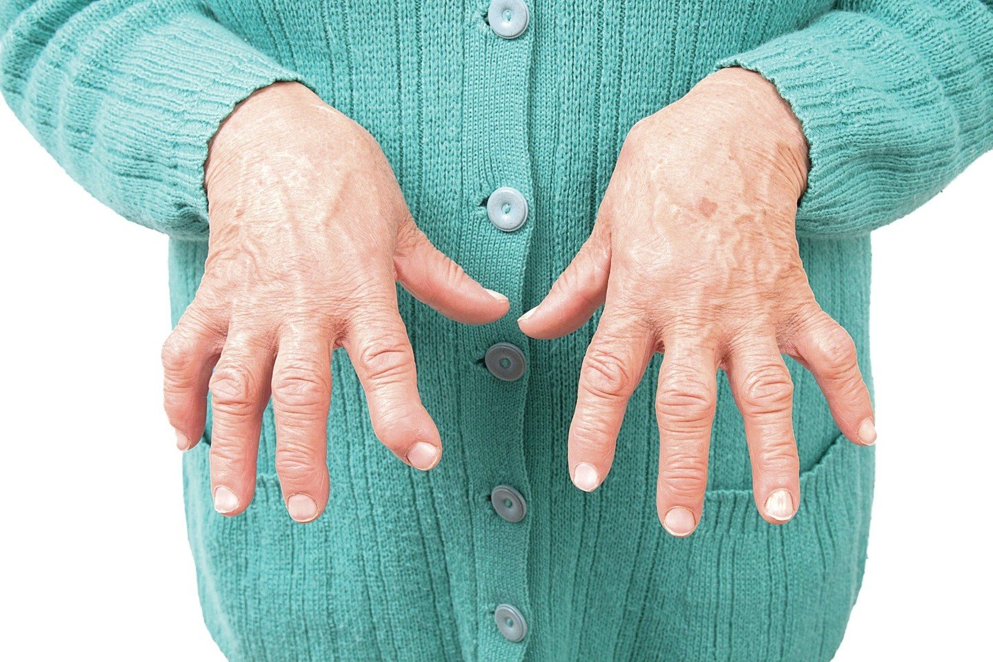 artritas pirštų ant rankų