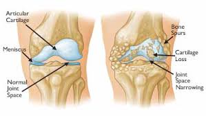 osteoartrito periferinių sąnarių gydymas