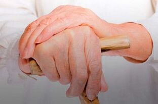 tepalas artritu pirštų sąnarių rankų gydymo