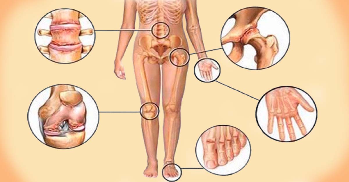 kad kenkia sąnariams 6 priežastys artrozės skauda peties sąnarys negali pakelti savo ranką