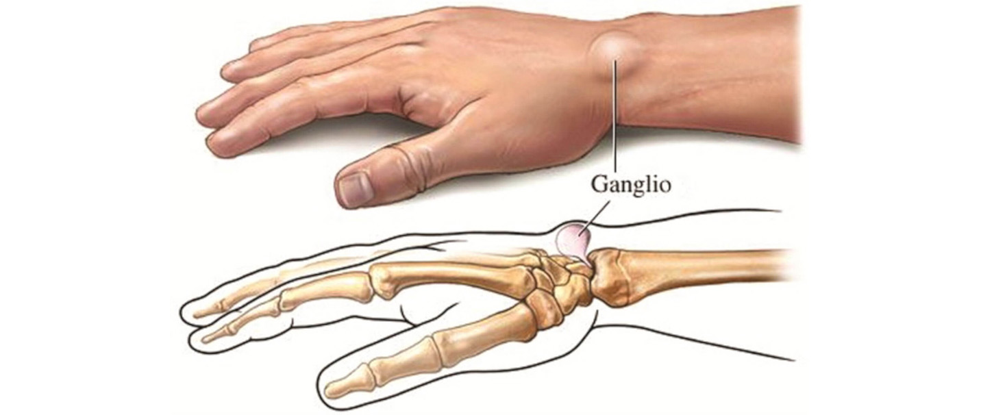 gydymas traumų pirštų sąnarių rankų gydymo artrozė rober gydymas