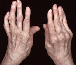 gydymas poliartritas peties sąnario liaudies gynimo priemones priežastys artrozės mažų sąnarių