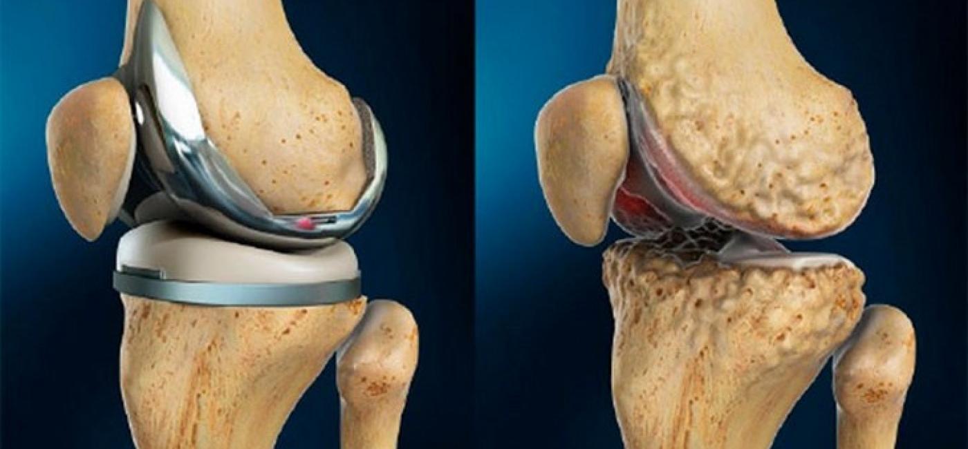 gydymas sąnarių 60 metų artritas iš dešinės kojos sąnarių
