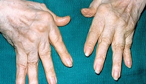 vedos balzamas sąnarių artrozė pėdų gydymas liaudies