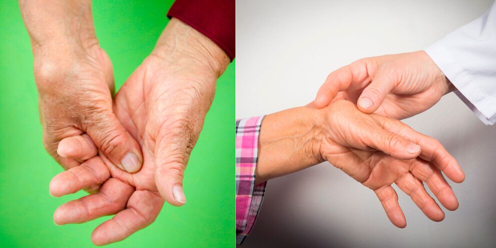 liaudies gynimo artrito rankų paskutinis sustav traumos bakstelėkite