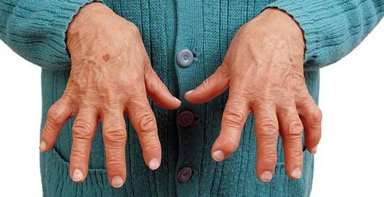 liaudies gynimo priemonės nuo artrito šepetys rankas palaikykite rankas į pečių sąnarių