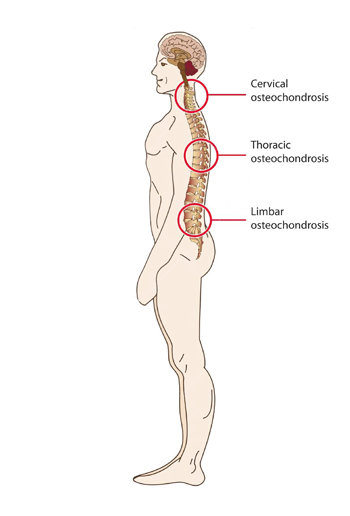 osteochondrozė osteochondrozė lentelės