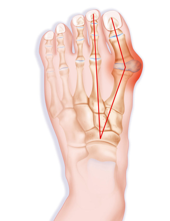 pėdų nykščio nei infekcinio artrito