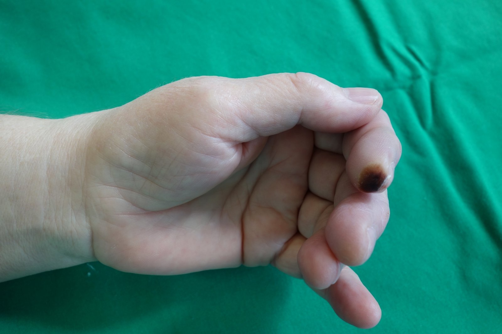 rankos opos gydymas epipudilite alkūnės sąnarių su tepalais
