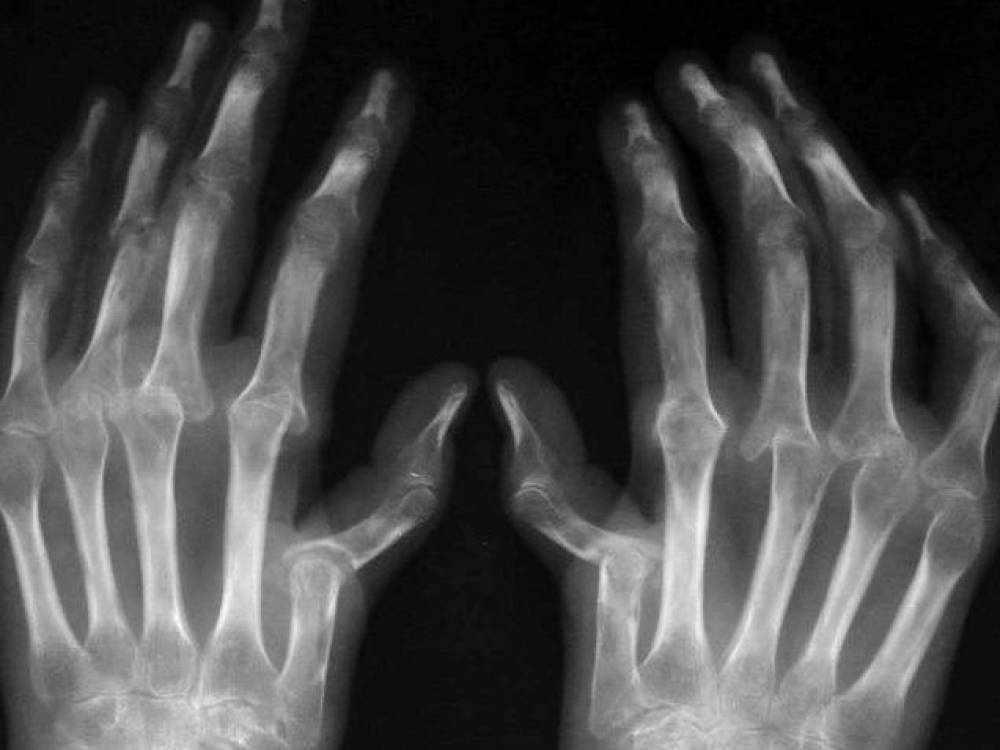 reumatoidinis artritas biologiniai vaistai topinambur už artrozės gydymo