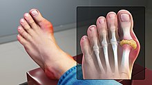 reumatoidinis artritas viki artritas mažų sąnarių pėdos gydymo